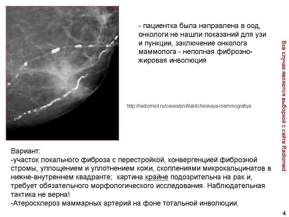 Что означает фиброзное изменение