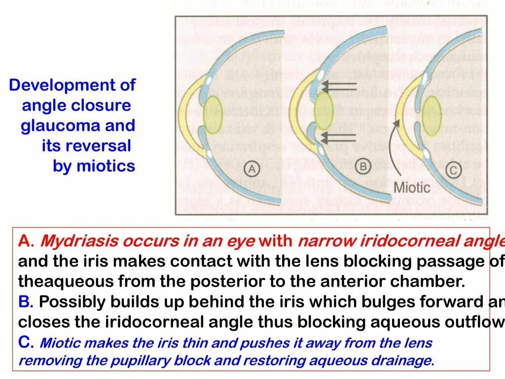 Глаукома клапан Ахмеда. Iridocorneal Angle. Глаукома латынь