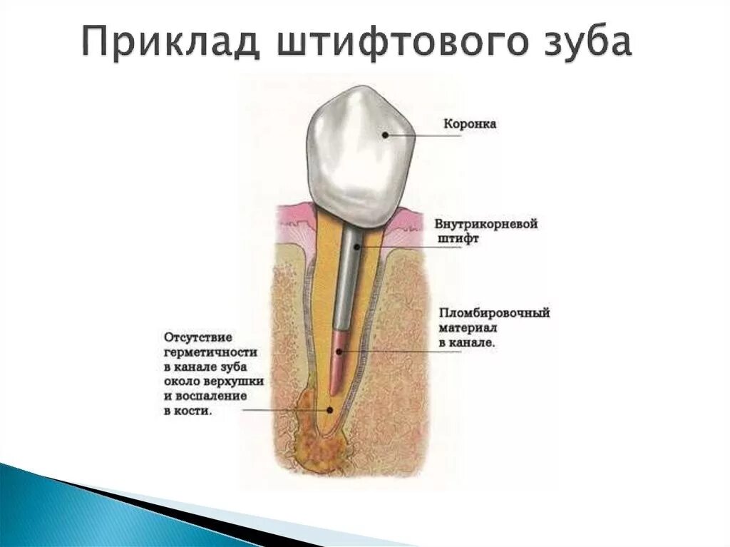 Что такое штифт в зубе. Штифтовые зубы. киста зуба под коронкой. металлический штифт в зубе.