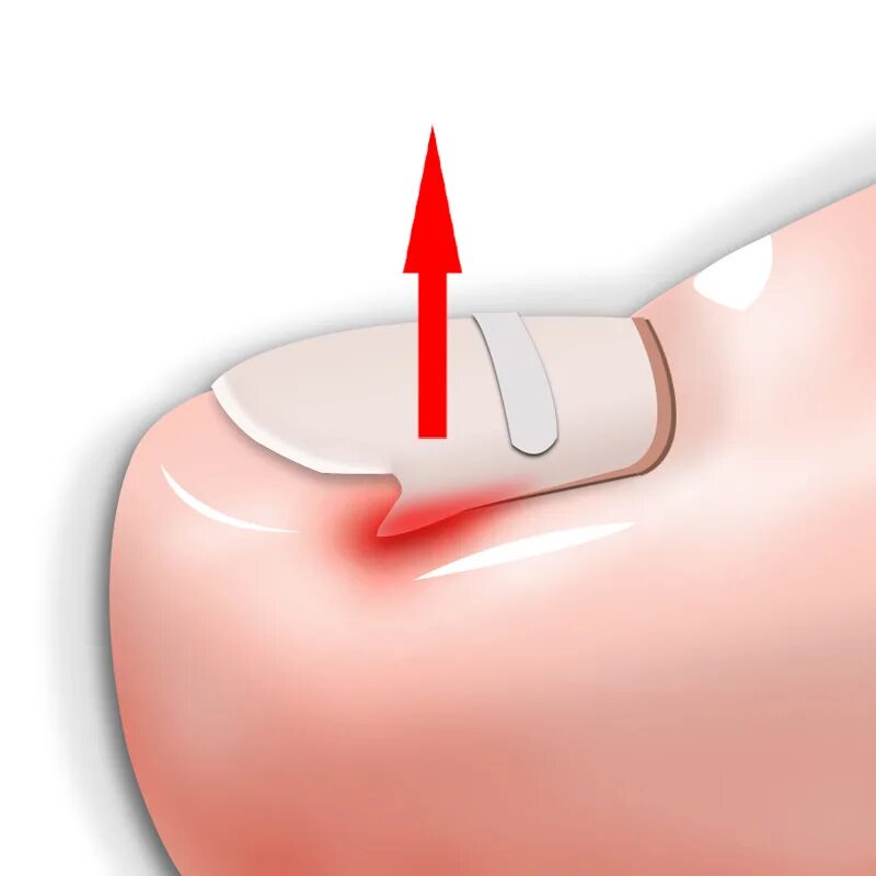 Впился ноготь что делать