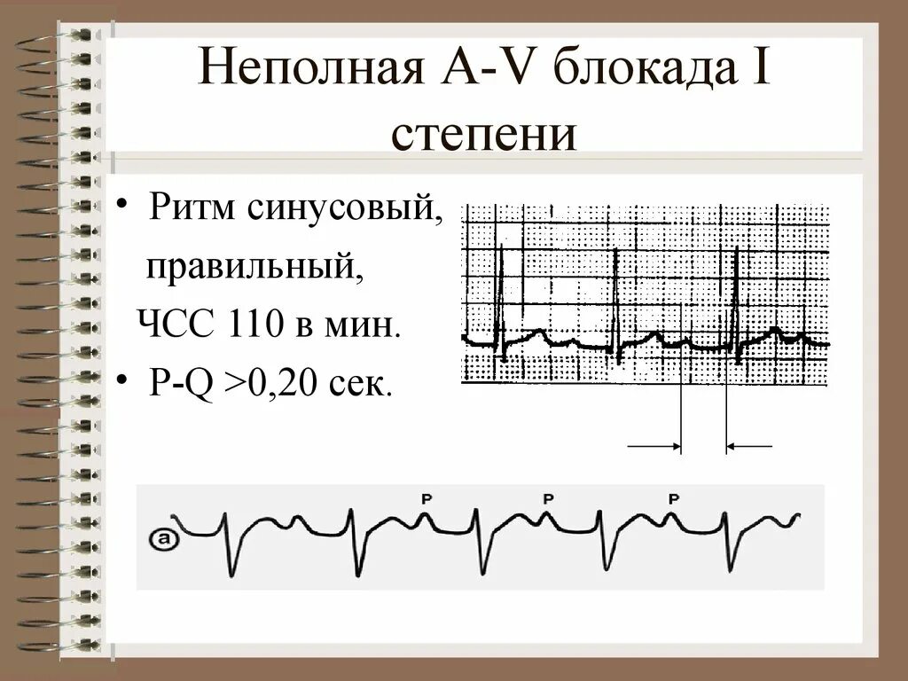 Неполная блокада лечение. Неполная блокада 1 степени. Ритм синусовый с a v блокадой 1 степени. АВ блокада 1 степени. A-V блокада 1 степени что это.