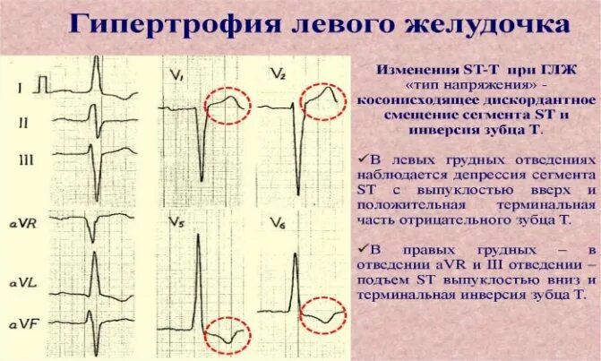 Гипертрофия левого желудочка как лечить. Гипертрофия левого желудочка сердца. изменения при гипертрофии левого желудочка. сегмент st при гипертрофии левого желудочка:. гипертрофия миокарда левого желудочка на экг.