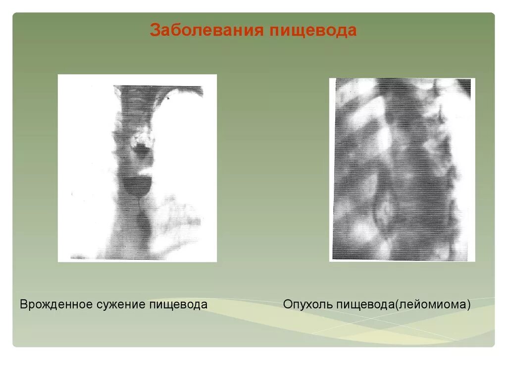 Нарушение пищевода