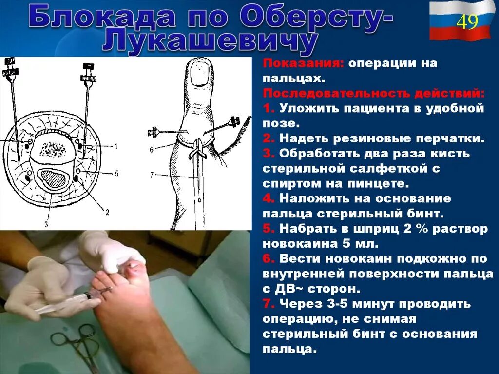 Проводниковая анестезия по Оберсту-Лукашевичу. Проводниковая анестезия по Оберсту-Лукашевичу показания техника. Проводниковая анестезия пальцев кисти. Методика анестезии по Оберсту-Лукашевичу. Проведение проводниковой анестезии