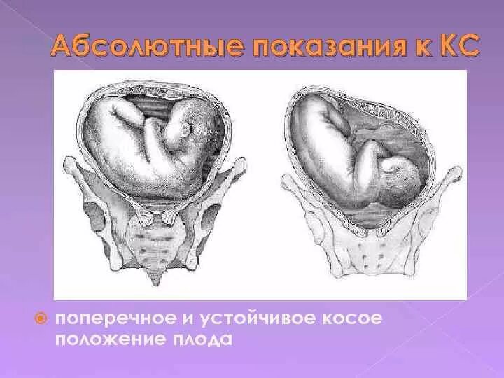 Позиция плода при поперечном положении. Поперечно головное предлежание плода. Головное косое предлежание плода. Головное предлежание косое положение плода. Поперечно продольное положение плода.