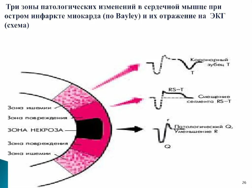 Алгоритм оказания помощи при инфаркте. Порочные круги при инфаркте миокарда. Патогенез некроза миокарда. Зоны ишемии по Бейли. Зона некроза при инфаркте миокарда.