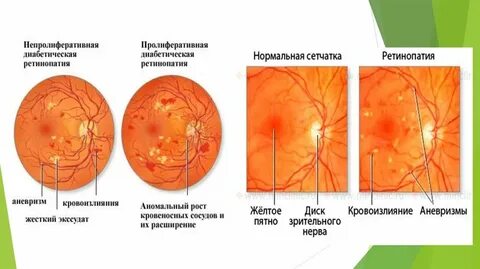 Диабетическая ретинопатия стадии