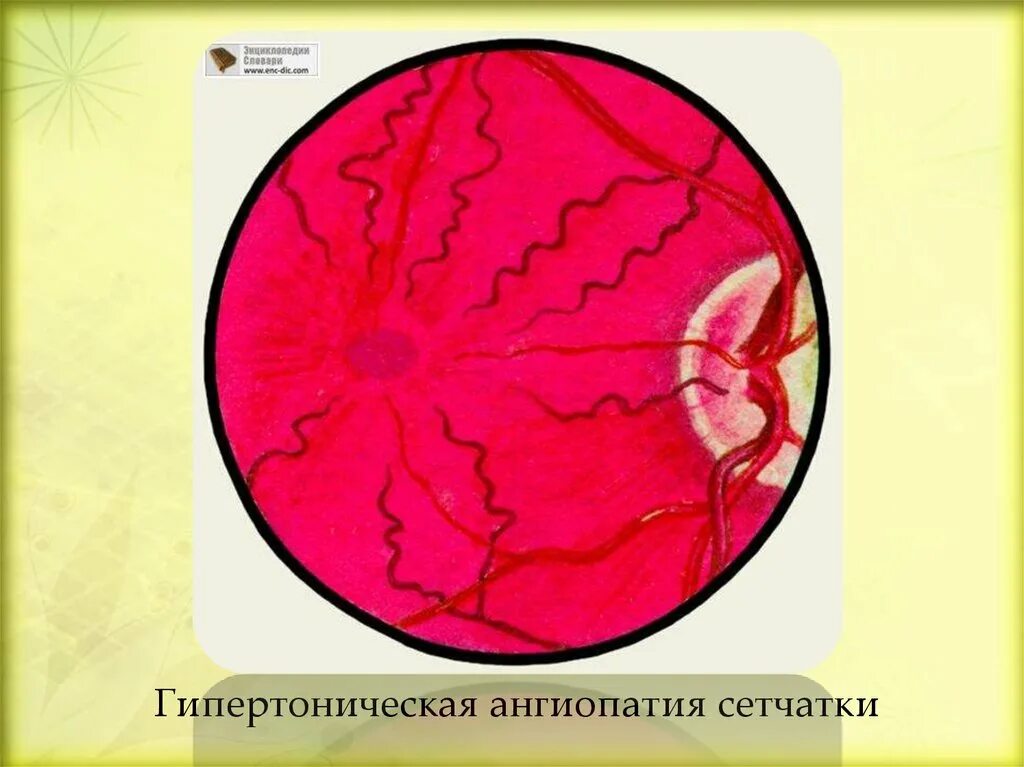 Гипертоническая ангиопатия глазное дно. Глазное дно симптом Гвиста. Ангиопатия сетчатки глаза ou. Ангиопатия сосудов сетчатки что это