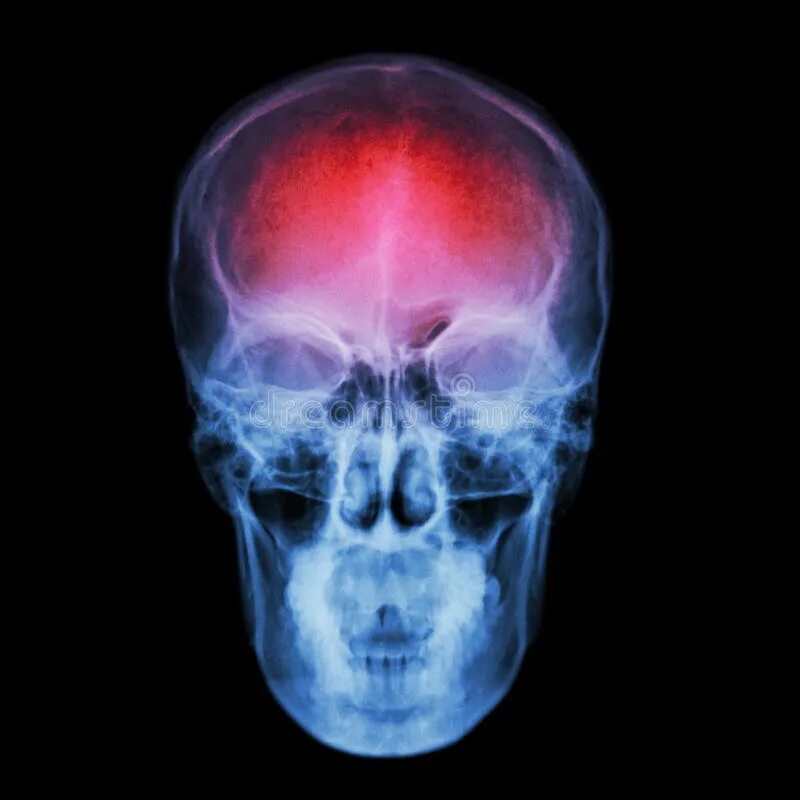X Ray of Skull. stock image. Image of open, right, bone - 74641553