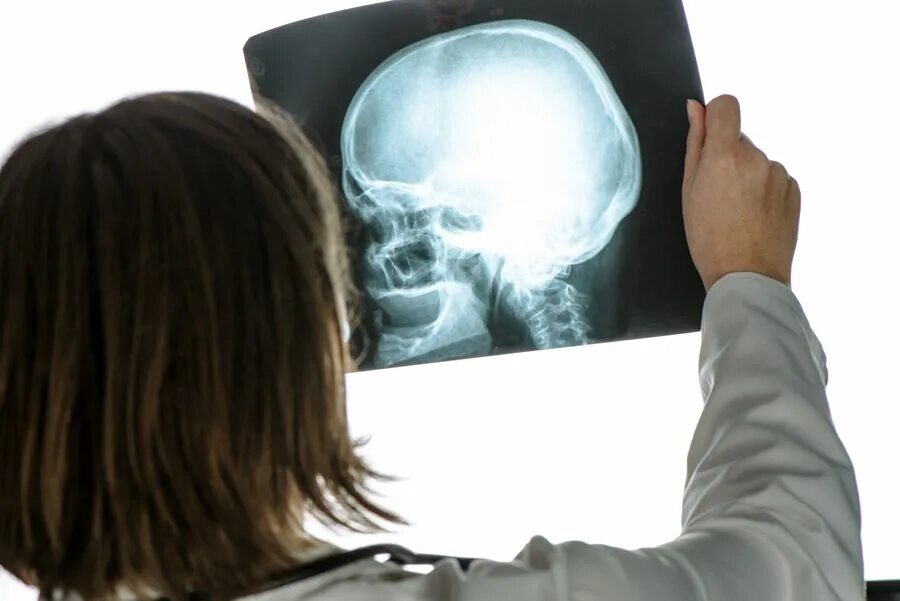 Сотрясение черепа. Рентгенография головы. Рентгеновский снимок головы.