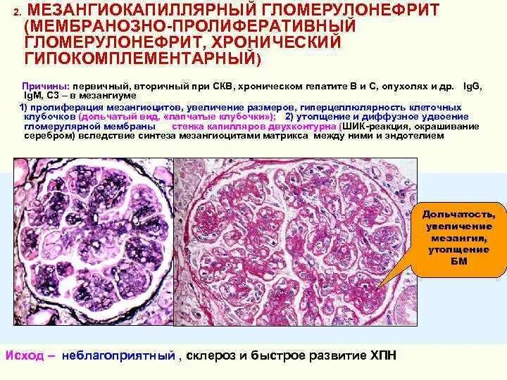 Мембранопролиферативный (мезангиокапиллярный) гломерулонефрит. Мезангиокапиллярный гломерулонефрит морфология. Мезангиокапиллярный гломерулонефрит гистология. Гломерулонефрит почки макропрепарат. Поражение клубочков почек