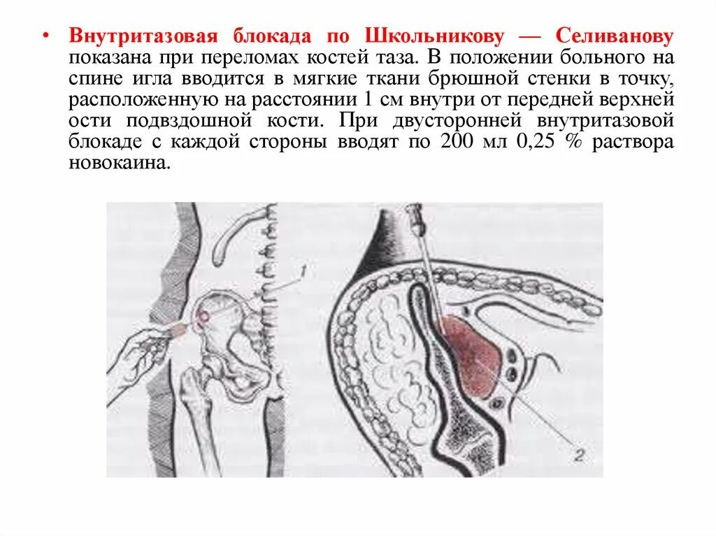 Блокады половые. Анестезия по Школьникову Селиванову. Техника внутритазовой блокады по Школьникову Селиванову. Блокада по Школьникову-Селиванову Цодыксу. Блокада Школьникова-Селиванова при переломе таза.