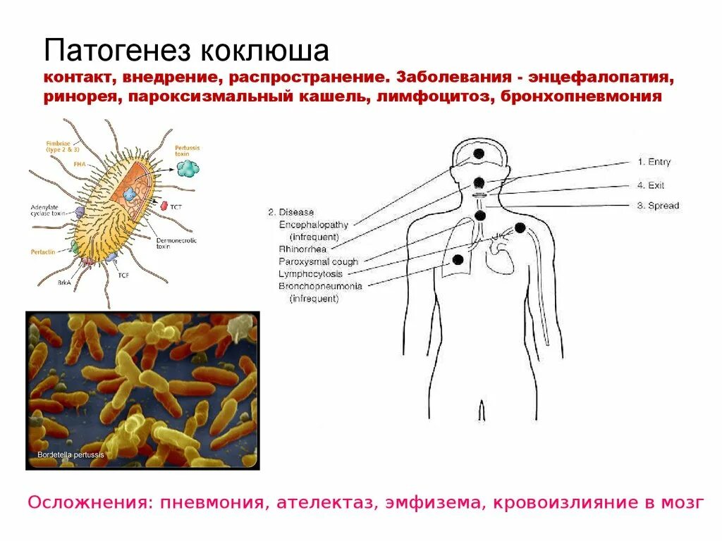 Эпидемиология и патогенез коклюша. Коклюш возбудитель болезни. Бактерия возбудитель коклюша. Коклюш клиника микробиология.