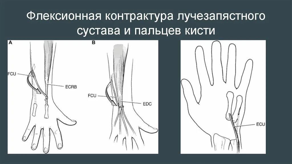 Контрактура сустава после перелома. Контрактура сгибателей. Сгибательно-разгибательные контрактуры кисти. Контрактура сустава кисти. Контрактура лучезапястного сустава.