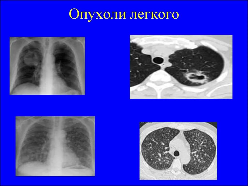 Лечение опухолей легкого. Злокачественная опухоль легких. Новообразование в легких. Злокачественное образование в легких. Злокачественное новообразование легкого.