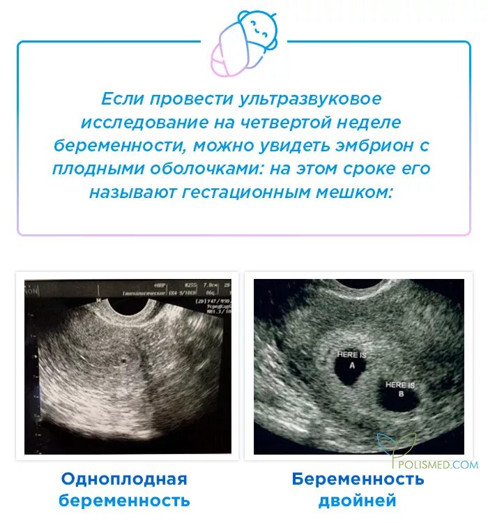 Эмбрион 4 недели беременности по УЗИ. Как выглядит зародыш в 3-4 недели на УЗИ. Эмбрион по УЗИ 3 недели беременности. УЗИ плода на 3 неделе беременности от зачатия. Неделя после зачатия что происходит