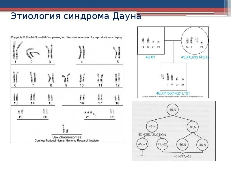 Синдром дауна наследственное или нет. Синдром дауна этиология. синдром дауна патогенез. синдром дауна схема. болезнь дауна этиология.