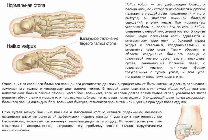 Ноющая боль в костях. Болит плюсневая кость стопы сбоку причины. Болят плюсневые кости свода стопы. Ушиб плюсневой кости большого пальца. Болит 5 плюсневая кость стопы.