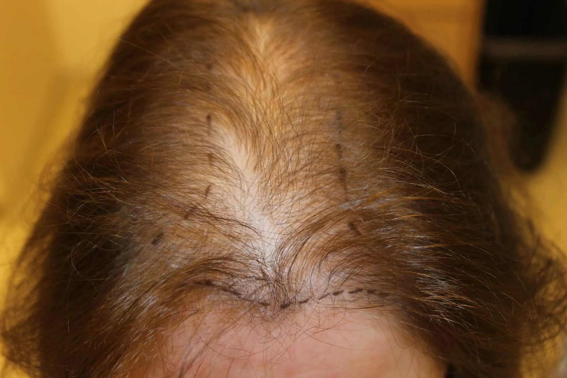 Асбестовидный себорейный дерматит. Выпадение волос у женщин. Поредение волос на голове.
