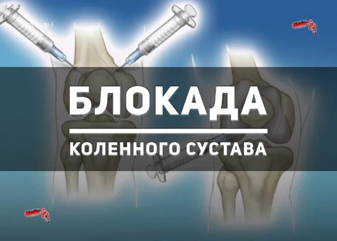Блокада коленного сустава. Блокада коленного сустава техника.