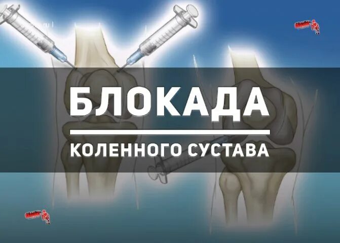 Блокада укол название. Блокада коленного сустава. Блокада коленного сустава техника. Новокаиновая блокада коленного сустава.