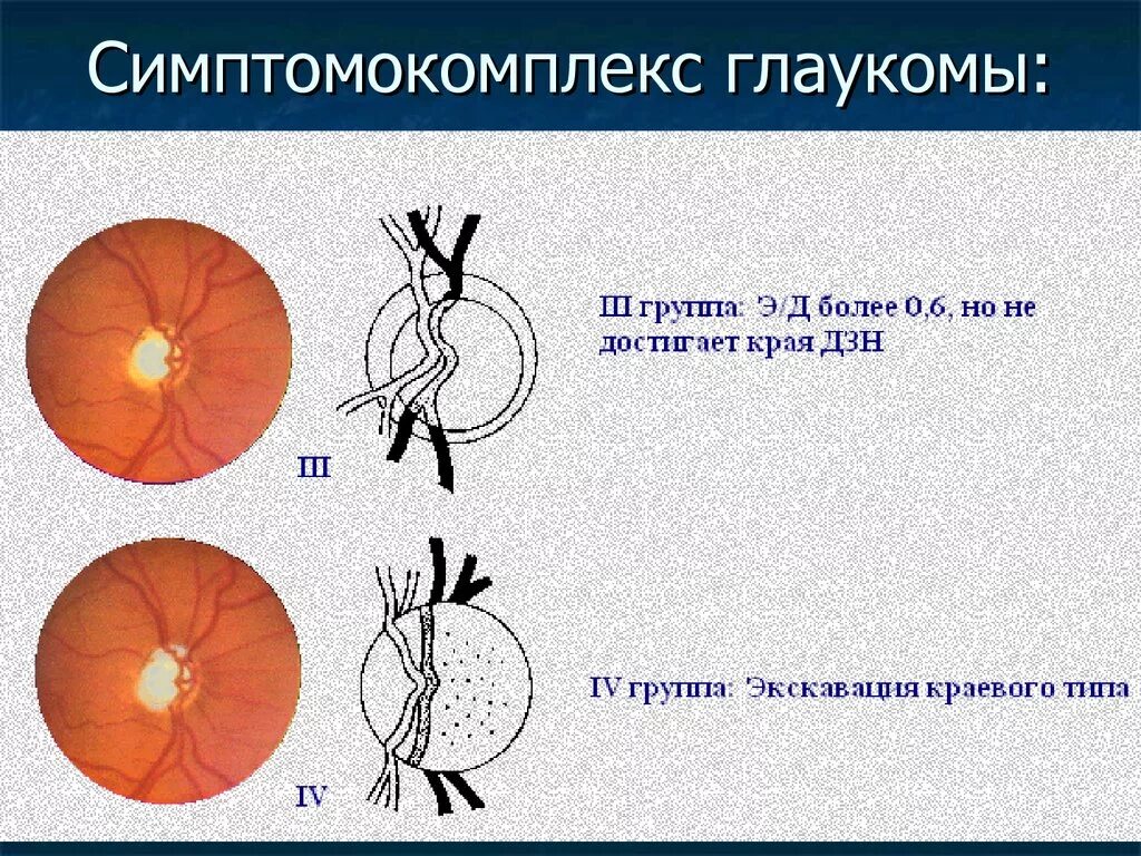 Зрительный нерв при глаукоме. Экскавация диска зрительного нерва норма. Экскавация диска зрительного нерва при глаукоме. Физиологическая экскавация ДЗН. Экскавация глазного дна.