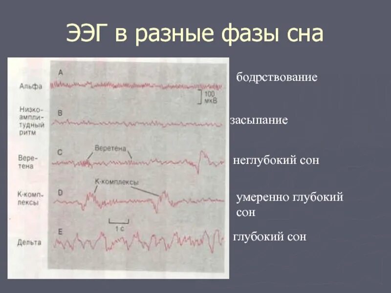 Ээг характеристика. Электроэнцефалограмма фаз сна. Стадии сна на ЭЭГ. Фазы сна показатели ЭЭГ. Фаза засыпания на ЭЭГ.