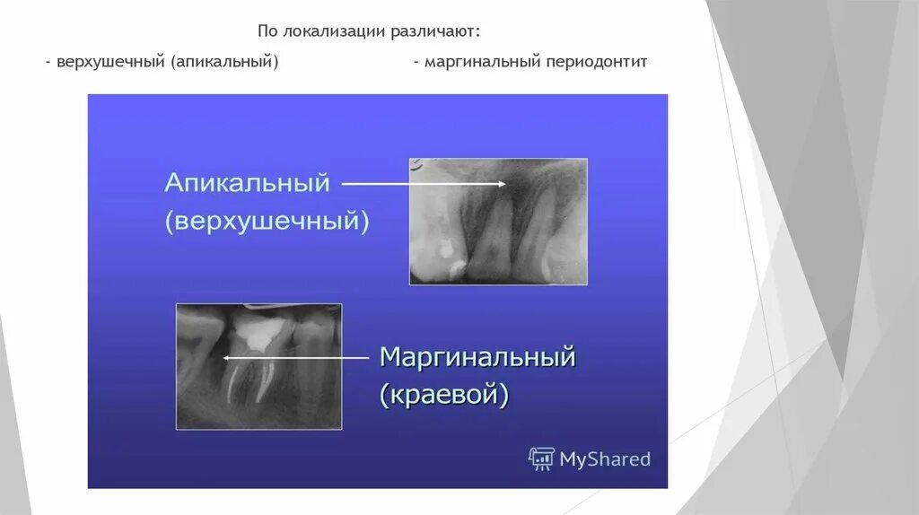 Апикальный и маргинальный периодонтит. Маргинальный периодонтит рентген. Верхушечный периодонтит. Острый апикальный периодонтит.