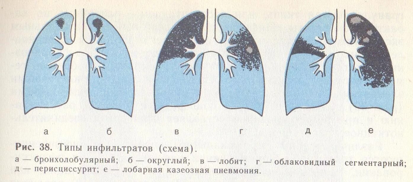 Округлыми формами в легком. Легочный инфильтрат классификация. Диссеминированный туберкулез легких схема. Инфильтративный туберкулез классификация. Типы инфильтратов при инфильтративном туберкулезе легких.