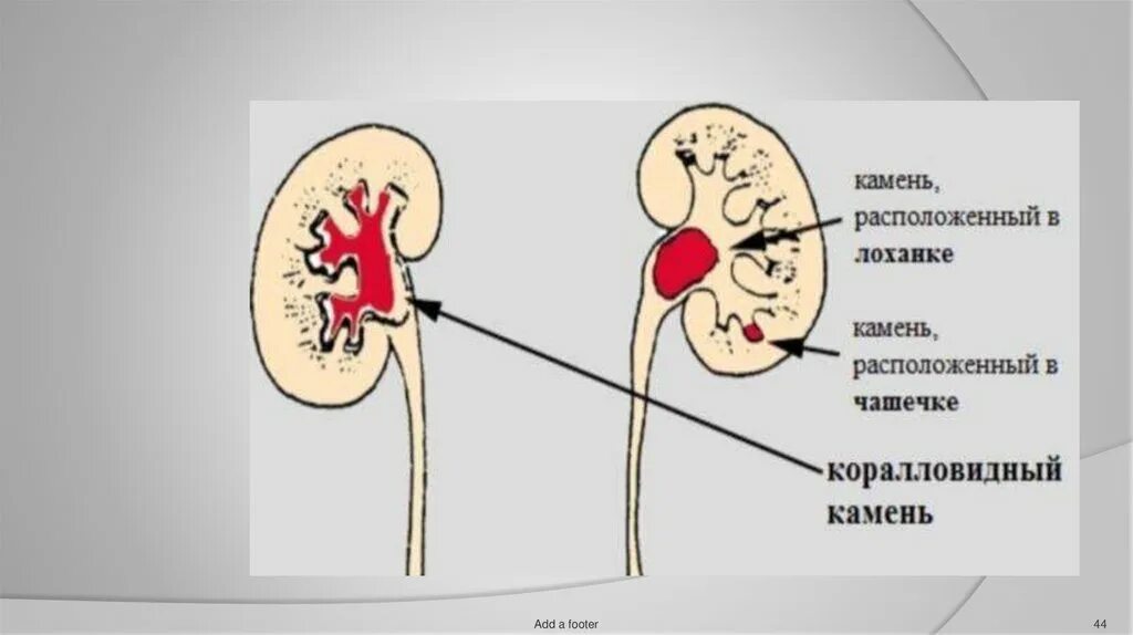 Почему лоханка. Мочекаменная болезнь коралловидные камни. Почечнокаменная болезнь (нефролитиаз). Камни в почках макропрепарат. Камни лоханки почки макропрепарат.