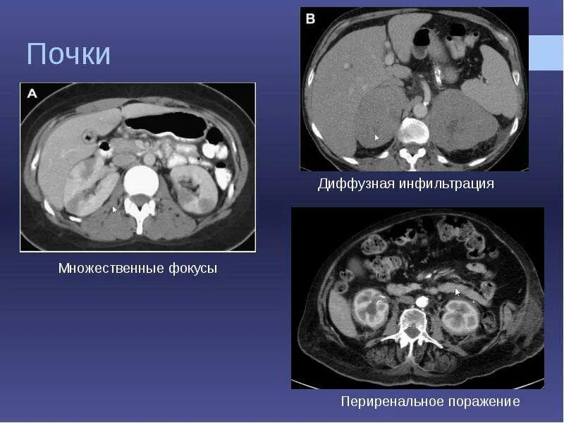 Диагностика лимфом. Периренального инфильтрата. Периренальные уриномы кт. Умеренные диффузные почек