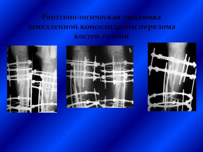 Что такое консолидация перелома. Замедленная консолидация переломов рентген. Консолидация переломов костей. Степени консолидации переломов рентгенология. Замедленная консолидация отломков.