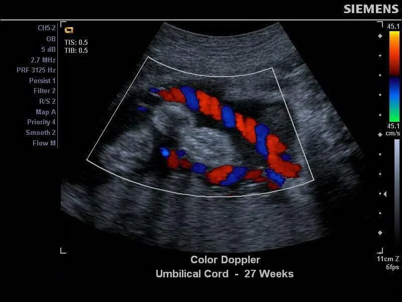 Доплер кровотоки. Ультразвуковое допплеровское картирование. Допплерография фетоплацентарного кровотока. Допплеровская ультразвуковая допплерография почек.. Допплер УЗИ при беременности.