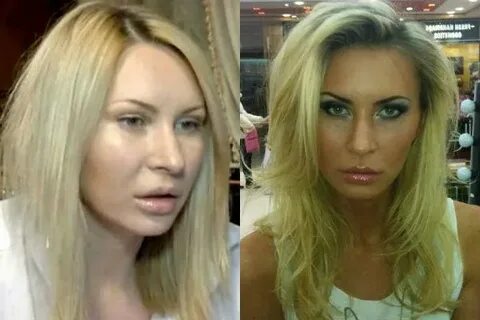 Рахимова до и после пластики