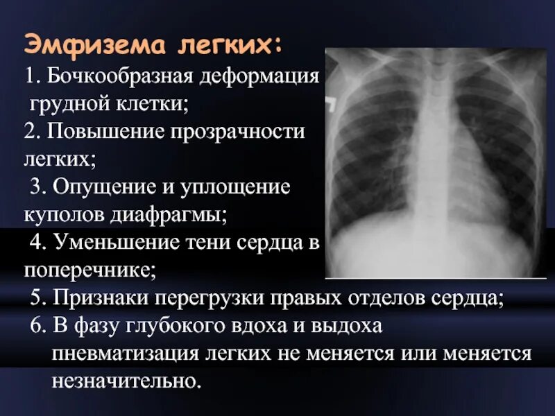 Эмфизема изменения. Рентгенография органов грудной клетки хобл. признаки эмфиземы легких на рентгене. эмфизема рентген описание. рентгенологические признаки эмфиземы легких.
