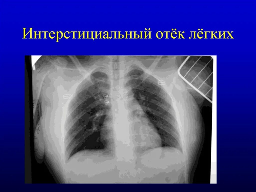 Альвеолярный отек легких рентген. Альвеолярный отек легкого рентген. Интерстициальный отек легких. Отек легких на рентгенограмме.