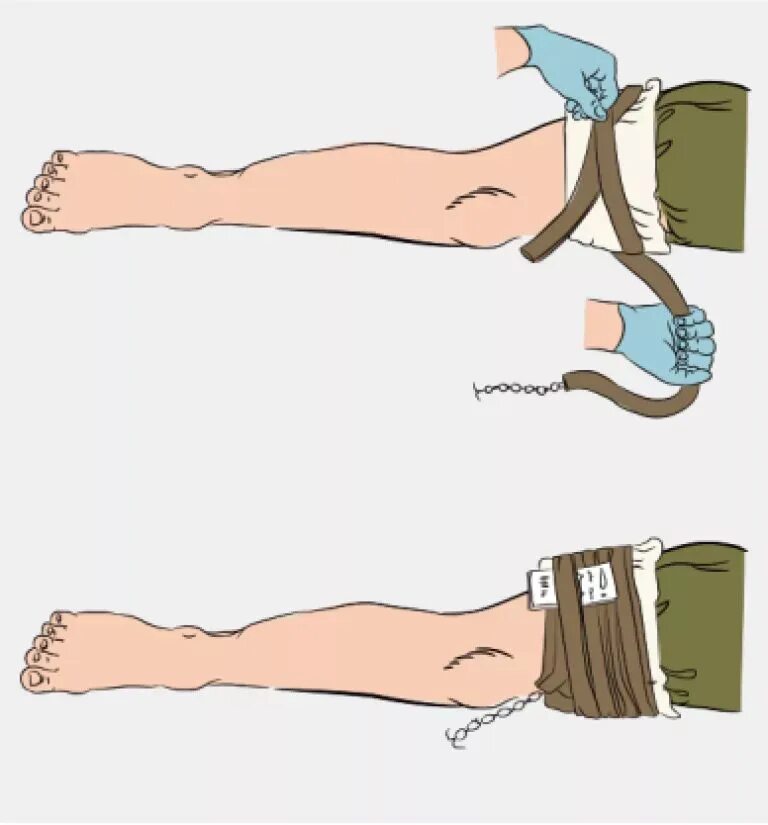 Артериальное кровотечение нижних конечностей. Техника наложения кровоостанавливающего жгута на конечность. Техника наложения кровоостанавливающего жгута на бедро. Наложение жгута Эсмарха. Наложение резинового жгута Эсмарха.