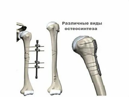 Операция плечевой кости после перелома