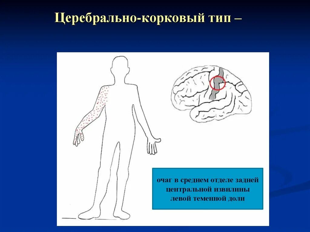 Церебральный корковый Тип нарушения чувствительности. Корковый Тип расстройства чувствительности. Корковый Тип нарушения чувствительности. Корковый Тип чувствительных расстройств.