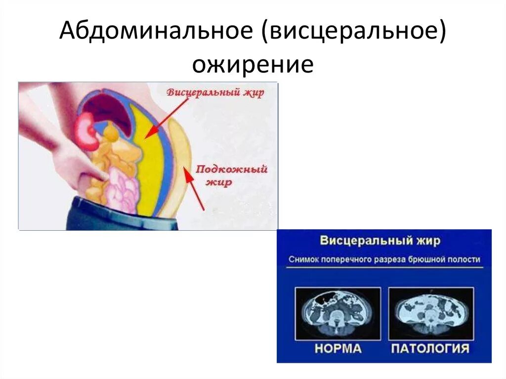 Висцеральный и абдоминальный Тип ожирения. Висцеральное ожирение патанатомия. Абдоминальное ожирение. Абдоминально-висцеральное абдоминальное-висцеральное ожирение.