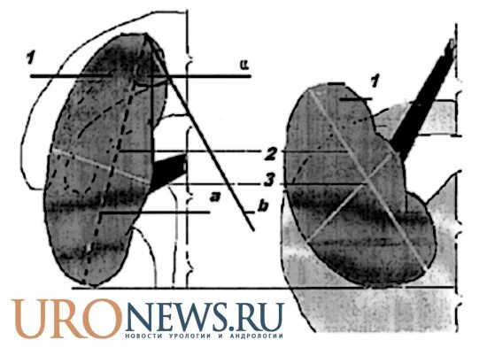 ротация почки