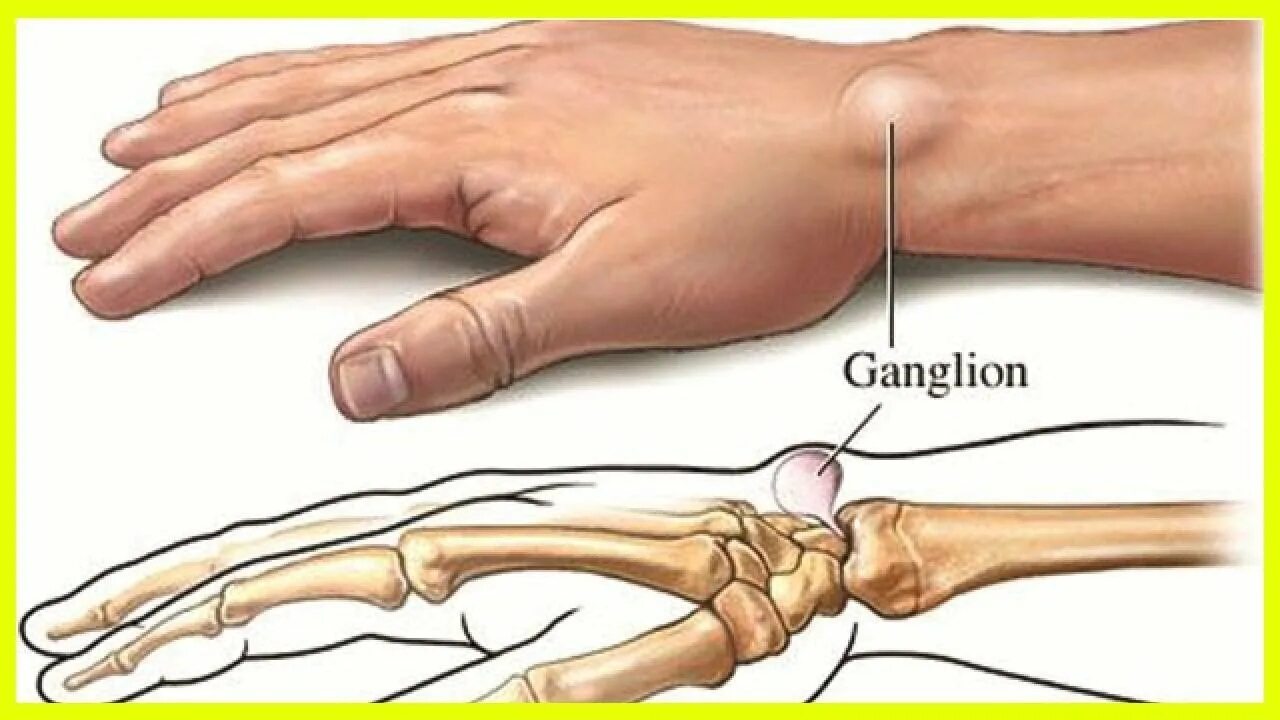 Гигрома лучезапястного сустава. Гигрома лучезапястного СУСТАВF. Синовиальная киста сухожилия. Болят пальцы и запястья
