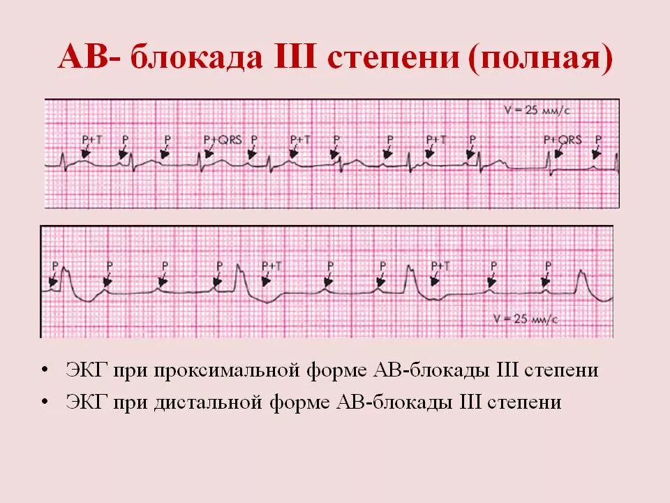 Полная АВ блокада 3 степени ЭКГ. Полная атриовентрикулярная блокада 3 степени на ЭКГ. АВ блокада 3 степени проксимальный и дистальный. ЭКГ критерии АВ блокады 3 степени. Fuller av