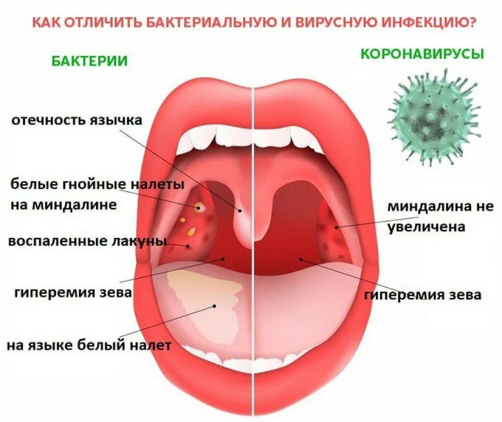 Бактериальная ангина зев.