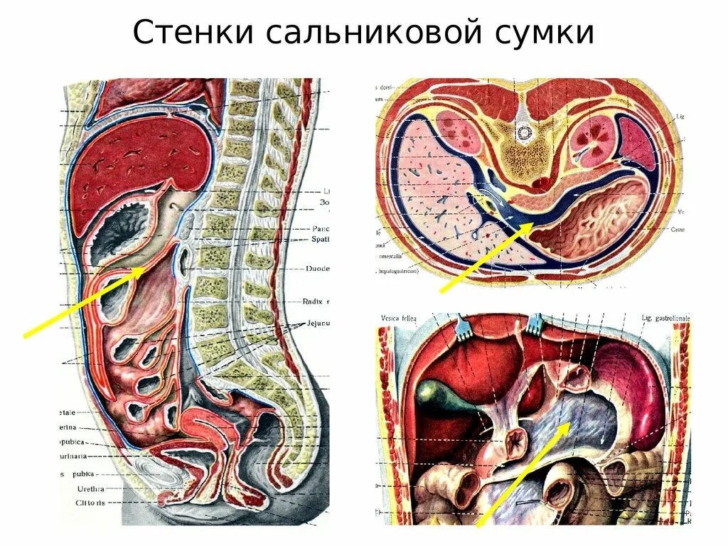 Винслово отверстие. Сальниковая сумка брюшины анатомия. Сальниковая сумка топографическая анатомия кт. Сальниковая сумка анатомия стенки. Преджелудочная сумка топографическая анатомия.