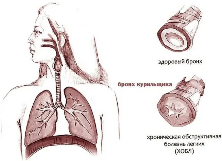 Хронический легкий кашель. ХОБЛ хронический бронхит курильщика. Хронический обструктивный бронхит курение.