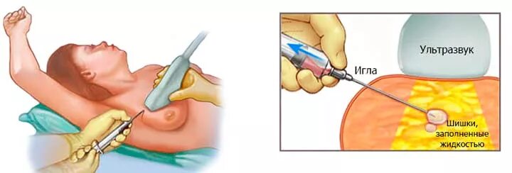 Пунция. Тонкоигольная пункция. Тонкоигольная пункция молочной железы. Тонкоигольная пункция под контролем УЗИ. Тонкоигольная аспирационная биопсия молочной железы.
