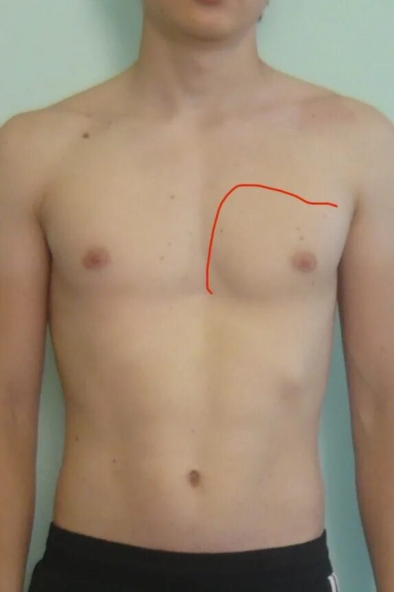 Килевидная форма грудной кл. Физиологические и патологические формы грудной клетки. Увеличени еобьема грудной леткм. Грудная клетка расширена в стороны. Воронкообразная деформация грудной клетки стадии.