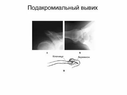 Подвывих ключицы