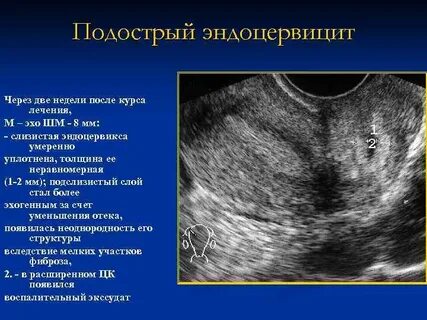 Эндометрий 8 мм что это значит